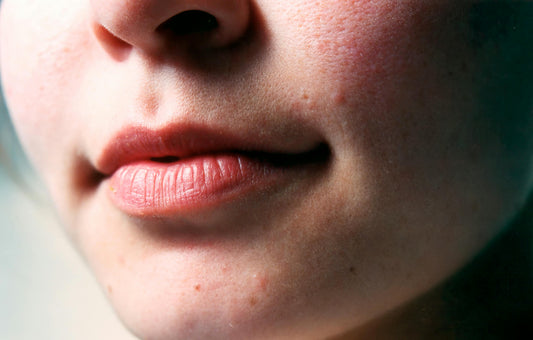 Inflammation cutanée : la comprendre pour l'apaiser