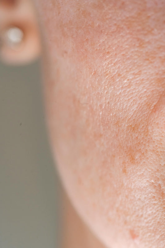 Comment réduire les pores dilatés ?